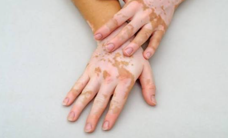 How Vitamin Deficiencies and Skin Conditions Can Cause White Patches in Children